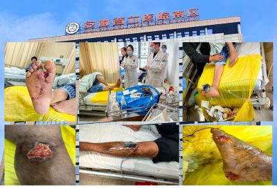 精准负压治疗新时代：便捷安科技助力负压引流新突破